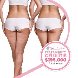 Tratamiento Celulitis - 6 Sesiones