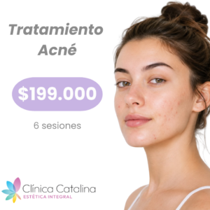 Tratamiento Acné
