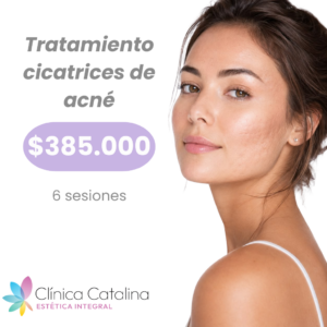 Tratamiento Cicatrices de Acné