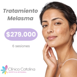 Tratamiento Melasma