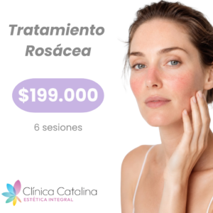 Tratamiento Rosácea