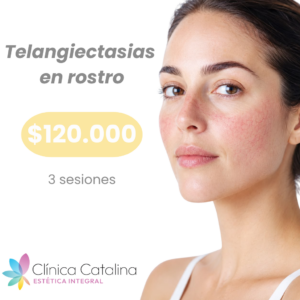 Telangiectasias en Rostro