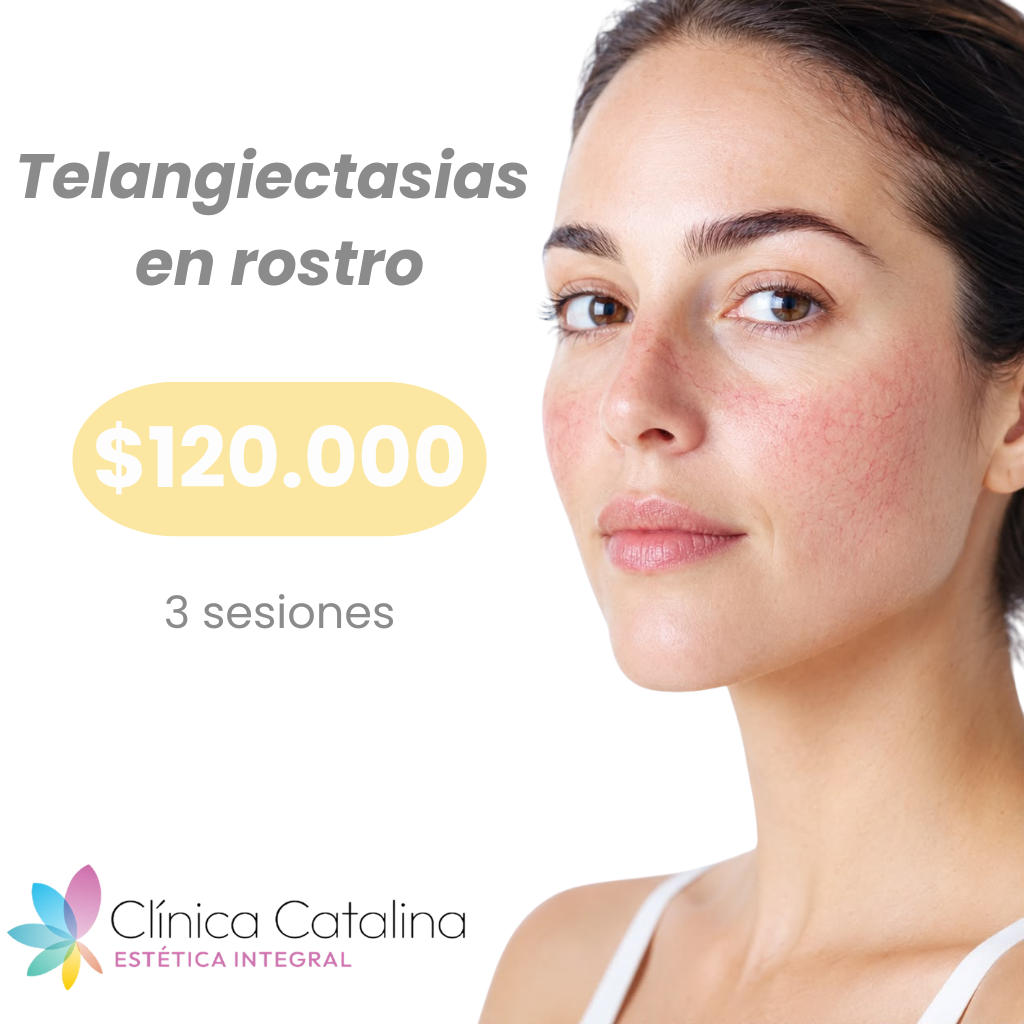 Telangiectasias en Rostro