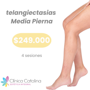 Telangiectasias en Media Pierna